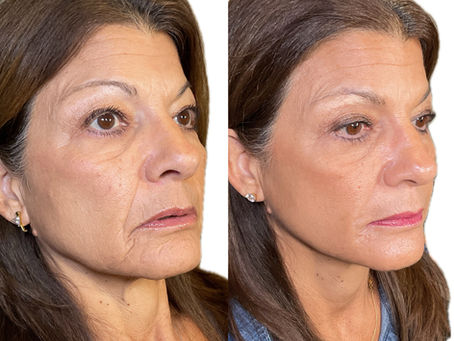 The Rise of Natural Aesthetics: How Velo Med Spa Is Redefining Anti-Aging