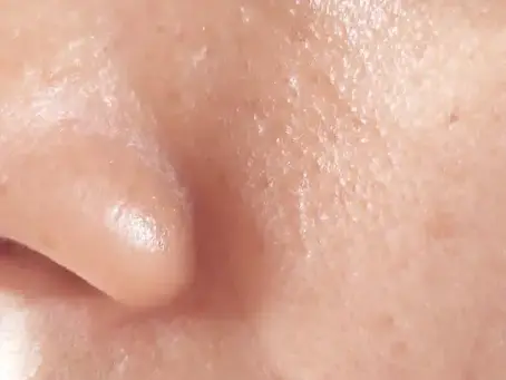 La peau grasse a besoin d'hydratation