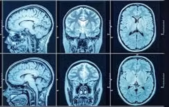 Esame TAC di un paziente dopo un Ictus cerebrale ischemico