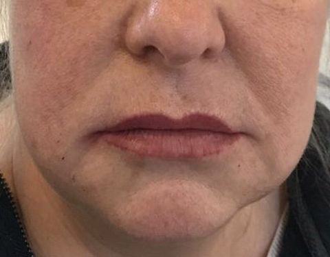 Marionette lines after using 1ml of filler.jpeg