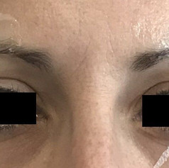 Brow treatment before