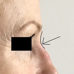 Non-surgical rhinoplasty before