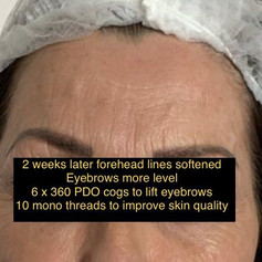 Eyebrow treatment after