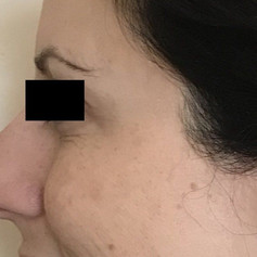 Crow's feet after