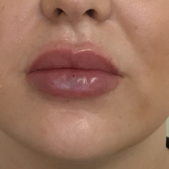 Fuller lips after