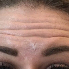 Forehead lines before