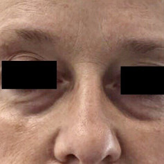 Under-eye hollows before