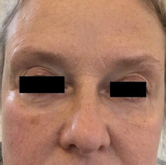 Under-eye hollows after