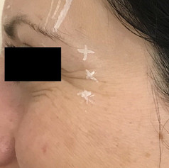 Crow's feet before