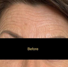 Eyebrow treatment before