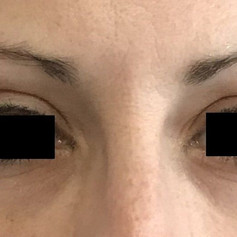 Brow treatment after