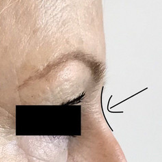 Non-surgical rhinoplasty after