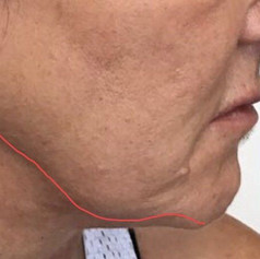 Jawline slimming before
