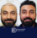 FUE Yöntemi ile Saç Ekimi Uygulaması