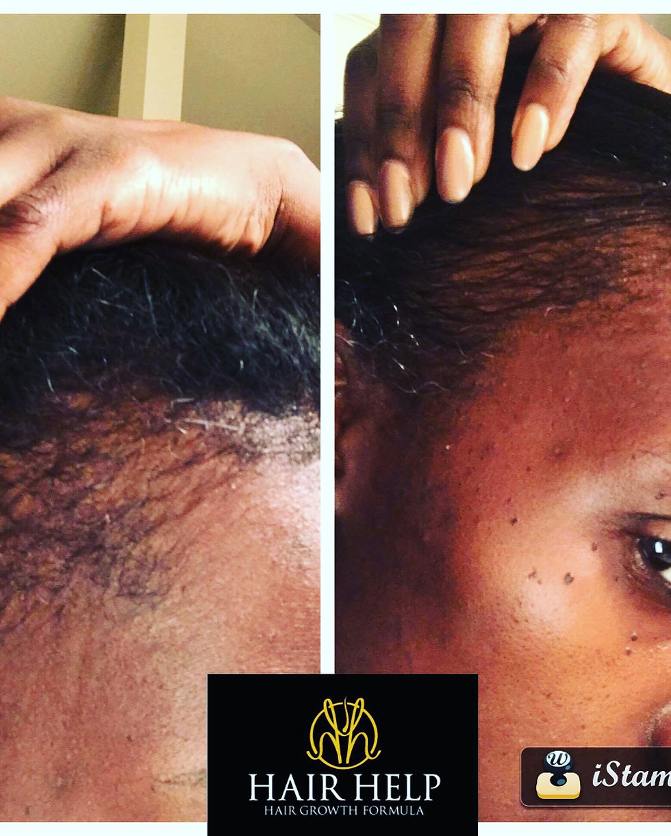Thumbnail: Hair Help Hair Regrowth Serm