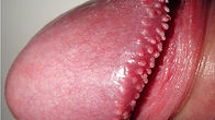 Pearly Penile Papules (PPP)