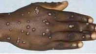 Genital Warts