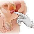 Prostatitis