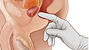 Prostatitis