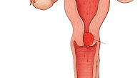 Cervical cancer