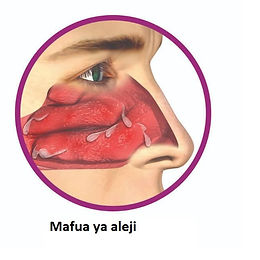 Dozi ya mafua ya Aleji