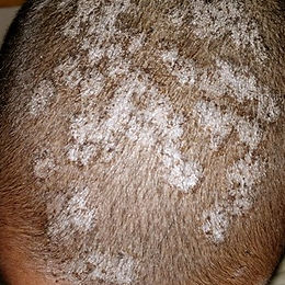 Dozi ya vibarango kichwani