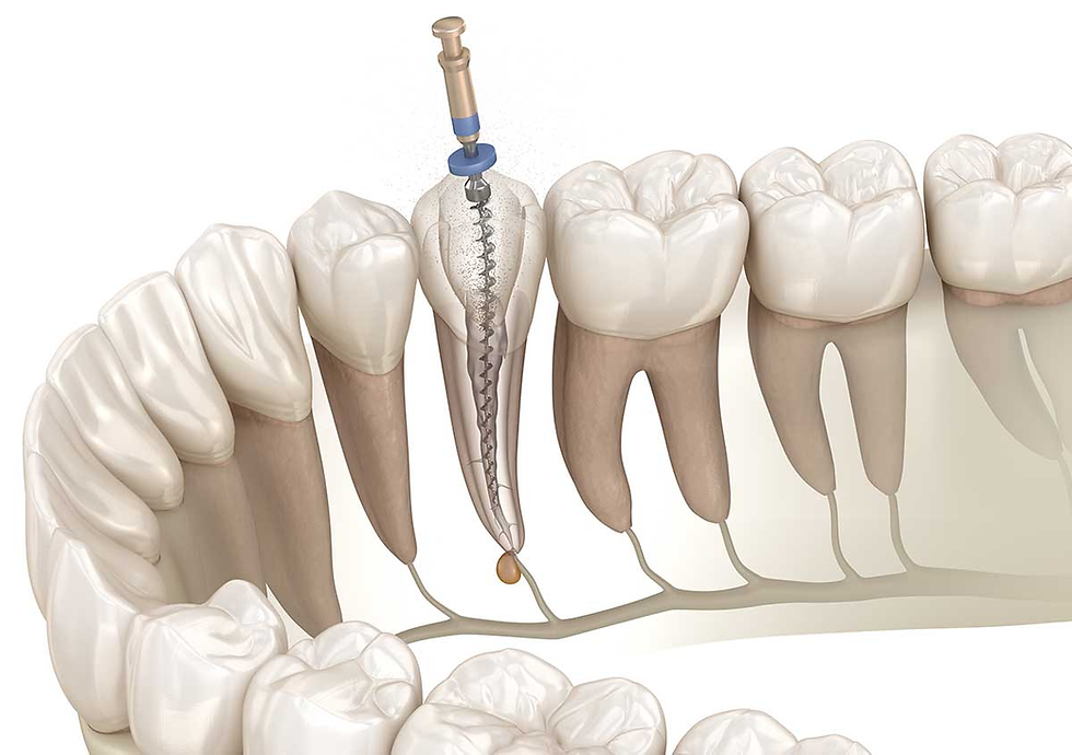 What Is Root Canal Treatment in Dubai Like Today?