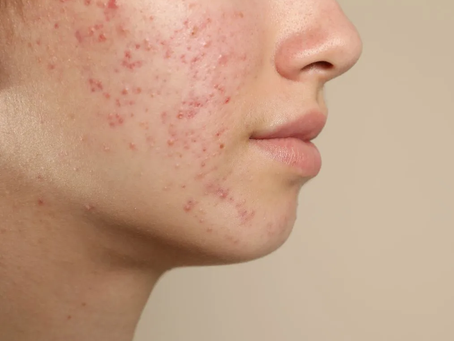 Why Pick Chemical Peel for Clearer Skin