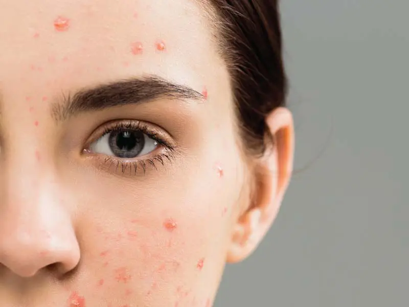 Acne Treatment Dubai