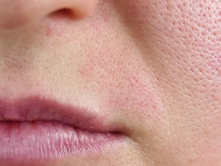 Be Bold, Be Sculpted – Try Laser Lipo