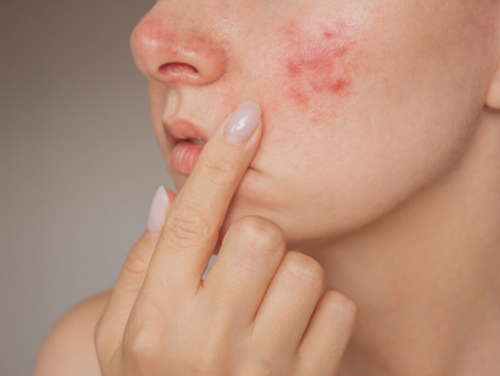 When Should Young Adults Try Acne Treatment Dubai?