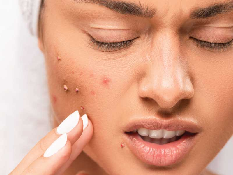 Acne Treatment Dubai