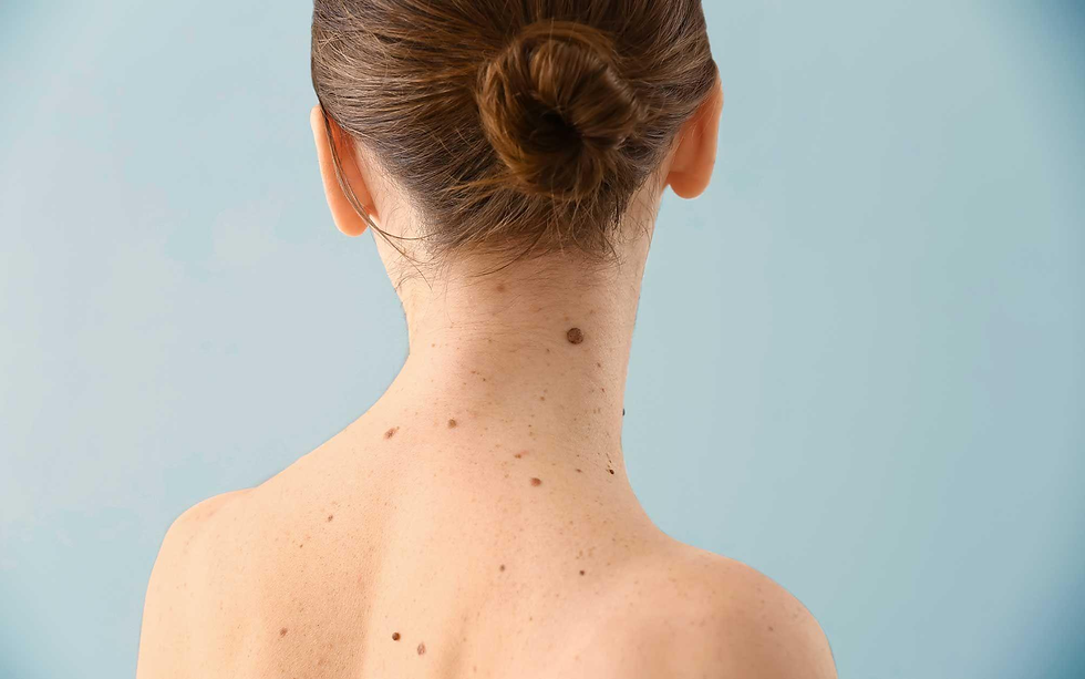 Skin tag removal in Dubai
