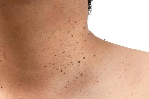 Why Do Skin Tags Appear? Insights from Dermatology Experts?