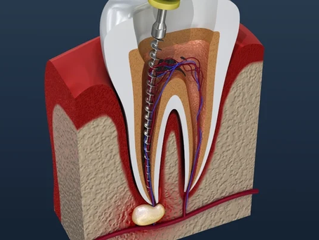 Root Canal Treatment for Infections: Your Complete Guide