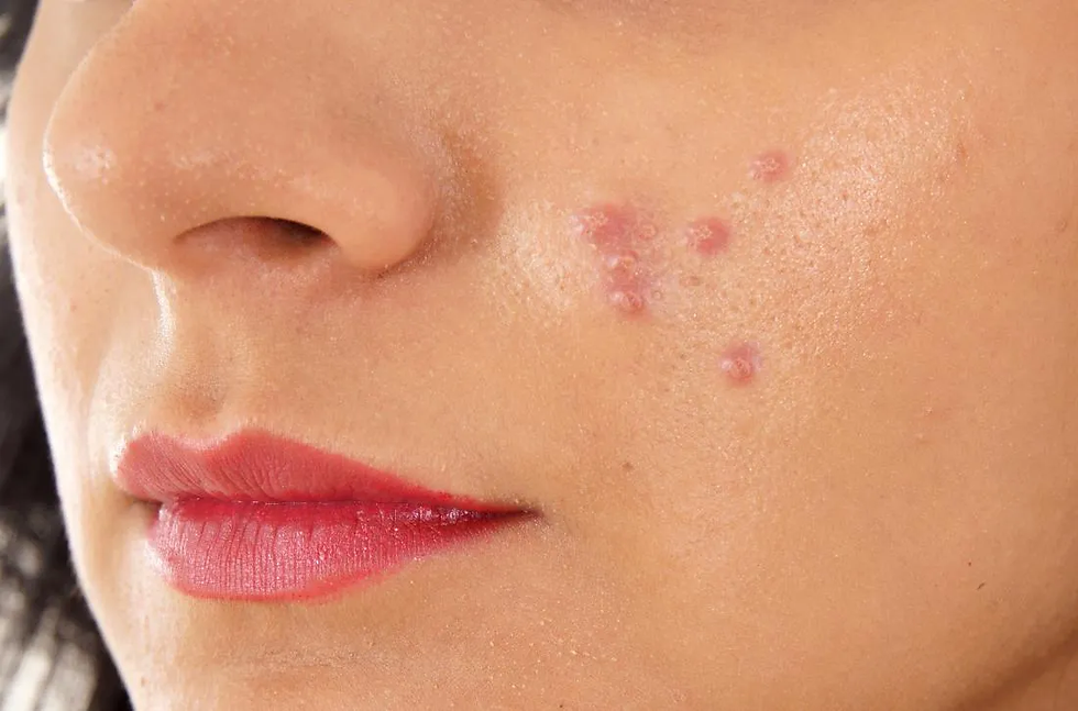 Acne Treatment Dubai