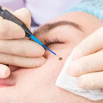 What Are Top Reasons for Mole Removal in Duba