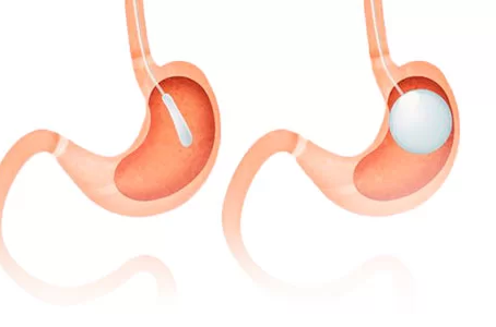 How Gastric Balloon Placement in Dubai Transforms Health