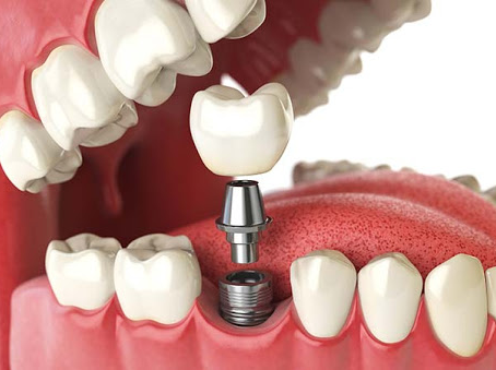What Happens During a Single Tooth Implant in Dubai?