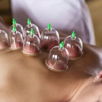 Hijama Cupping Therapy