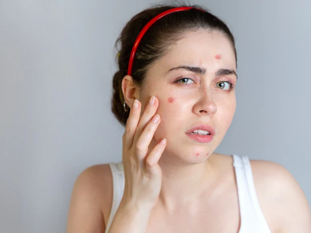 Why Follow-Up Matters in Acne Treatment