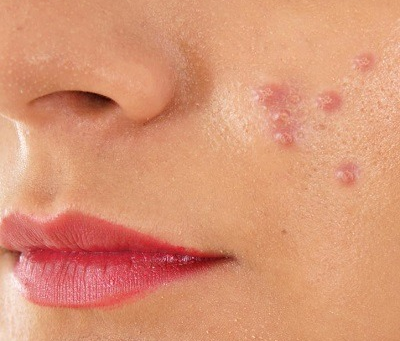 Top Acne Scar Treatment Options in Dubai in 2025: What Works Best?