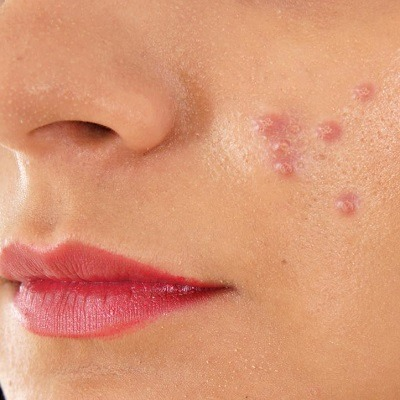 Top Acne Scar Treatment Options in Dubai in 2025: What Works Best?