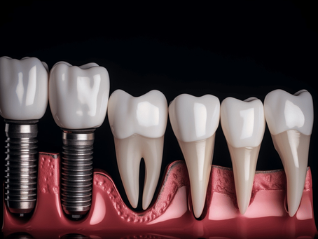 Athletes and the Benefits of Single Tooth Implant in Dubai