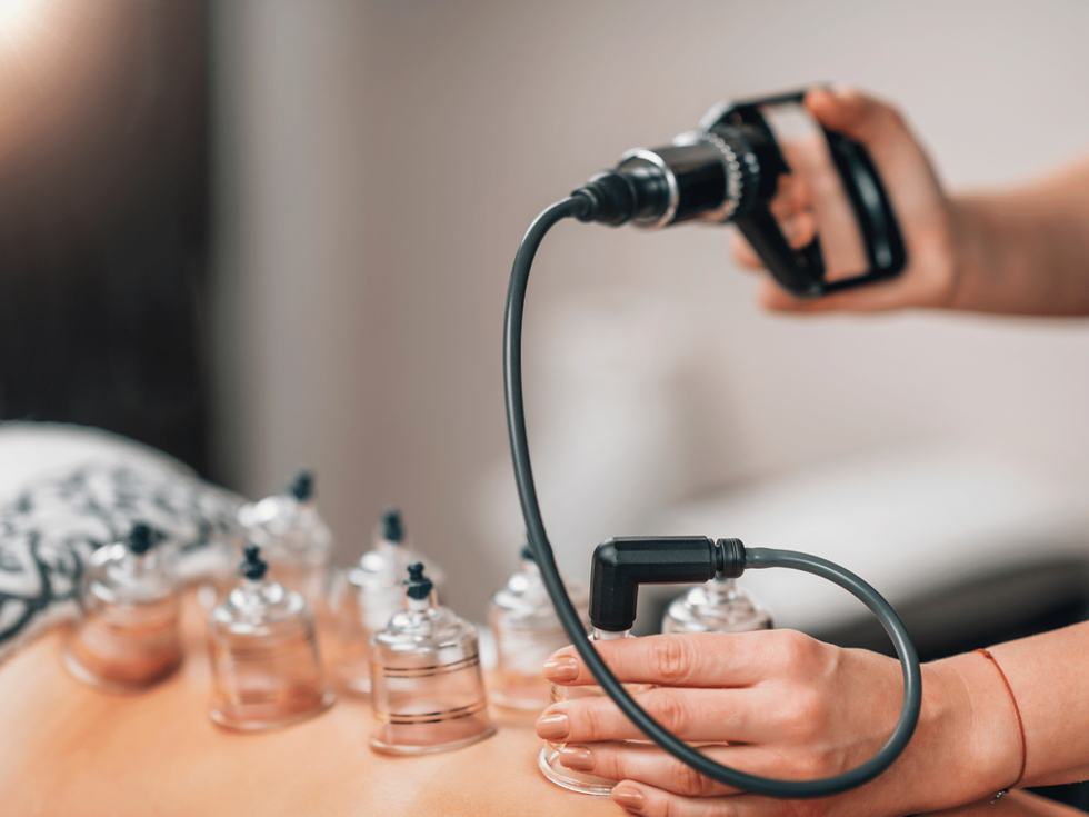 Hijama Cupping Therapy in Dubai