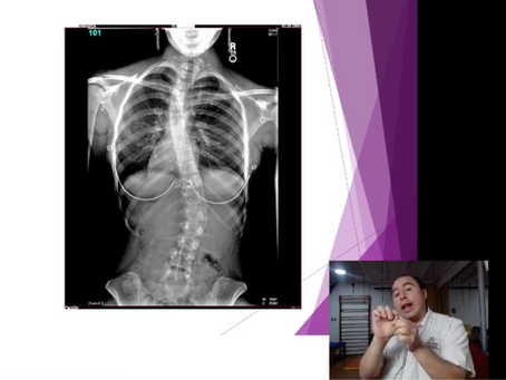 Problemas Posturales en el SÃndrome de Rett.