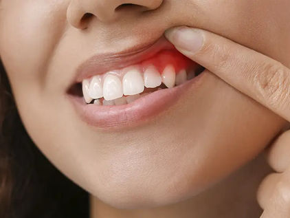 Gingivitis: la alarma silenciosa en tus encías.