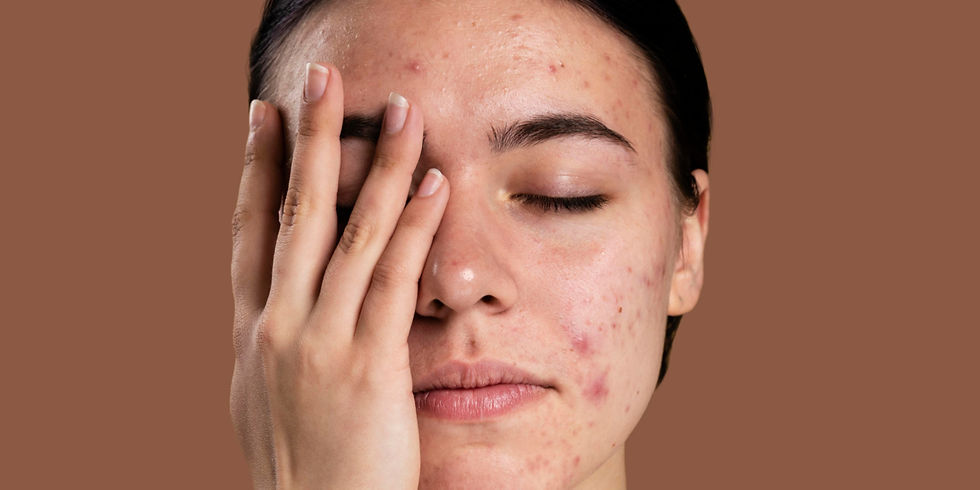 Tratamento de acne Julyanna do Valle