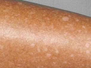 O que é leucodermia solar