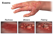 Understanding Eczema